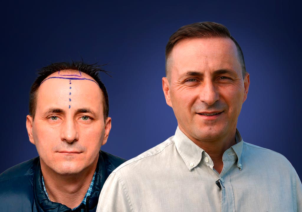 Pacjent Adam przed i po zabiegu przeszczepu włosów