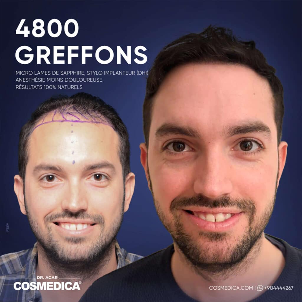 Résultats avant-après d'une greffe de cheveux Micro Saphir DHi de 4800 greffons chez Cosmedica