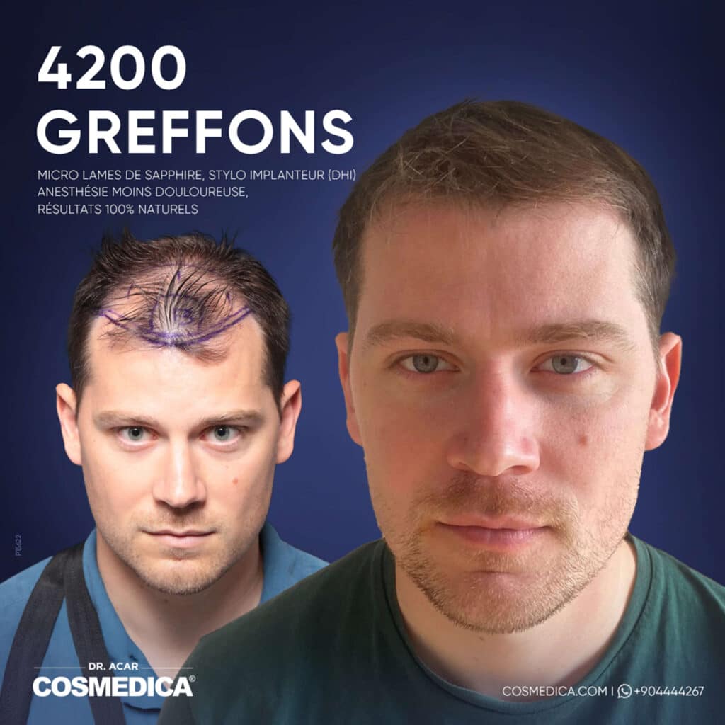 Résultats avant-après d'une greffe de cheveux Micro Saphir DHi de 4200 greffons chez Cosmedica