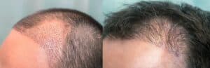 Greffe de cheveux 2 mois après avec évolution de la ligne frontale