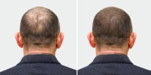 Greffe de cheveux 3 mois après avec amélioration visible de la couronne