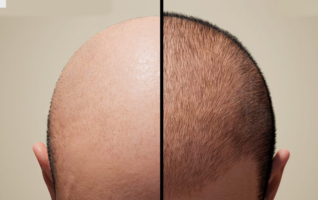Greffe de cheveux 3 mois après montrant la repousse progressive des cheveux