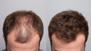 Greffe de cheveux après 1 an : résultat final avec couverture capillaire améliorée et chevelure plus homogène
