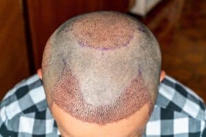 Haartransplantatie na 2 weken: herstellende hoofdhuid met zichtbare grafts en een genezende transplantatiezone.