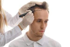 Médico marcando la frente de un hombre con problema de pérdida de cabello para un trasplante capilar de 5000 folículos