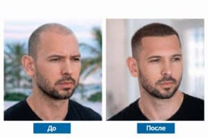 Эндрю Тейт до и после пересадки волос