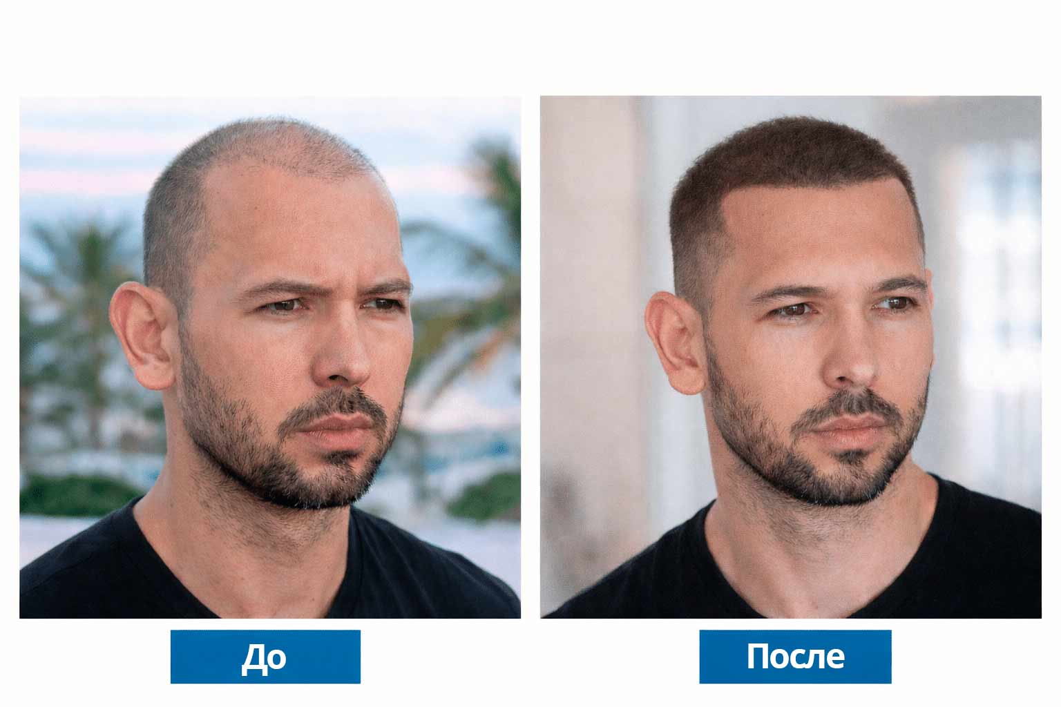 Эндрю Тейт до и после пересадки волос