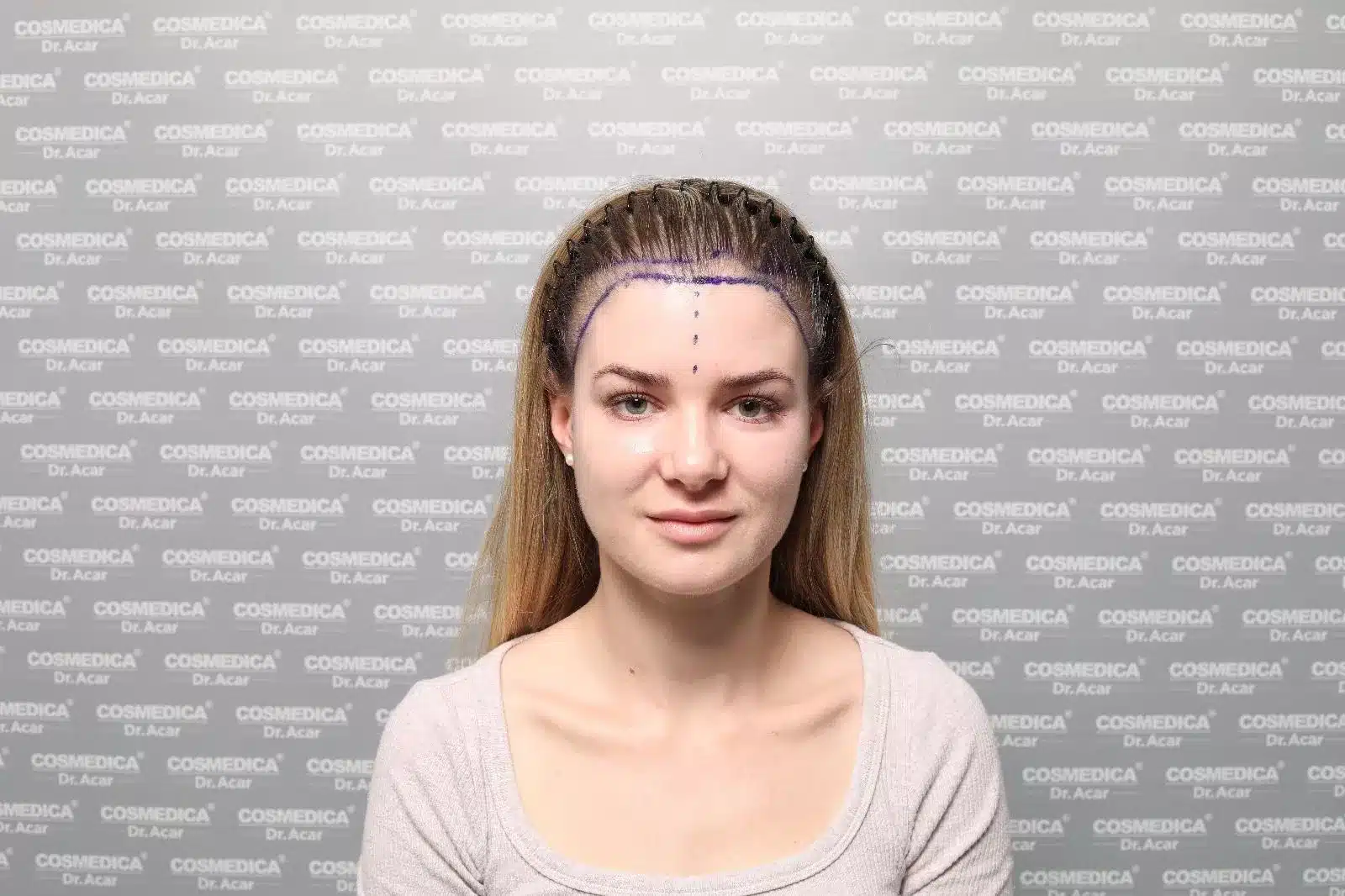 Nicole vor der Haartransplantation bei Frauen mit eingezeichneter Haarlinie bei Cosmedica