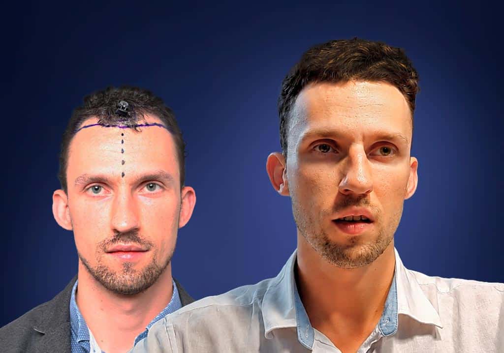 Zdjęcie Dawida przed i po przeszczepie włosów