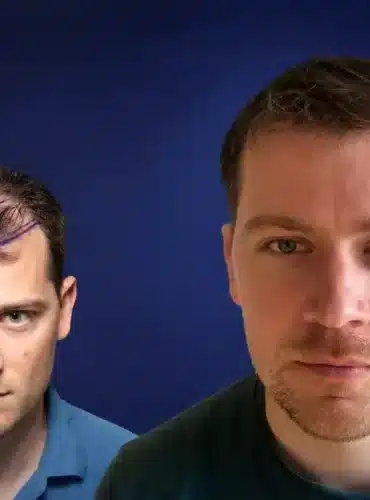 Vorher-Nachher-Frontansicht von Romain C. nach einer Haartransplantation in der Türkei mit 4.200 Grafts bei Cosmedica in Istanbul