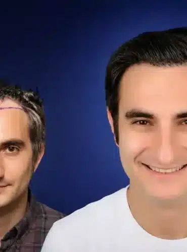 Vorher-Nachher-Frontansicht von Pau R. nach einer Haartransplantation in der Türkei mit 4.500 Grafts bei Cosmedica in Istanbul