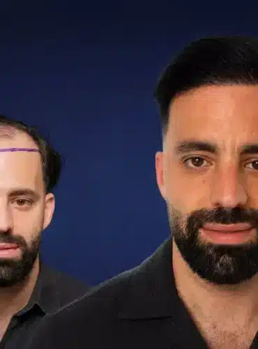 5000-grafts-haartransplantation-tuerkei-vorher-nachher-kevin-s-cosmedica-dr-acar