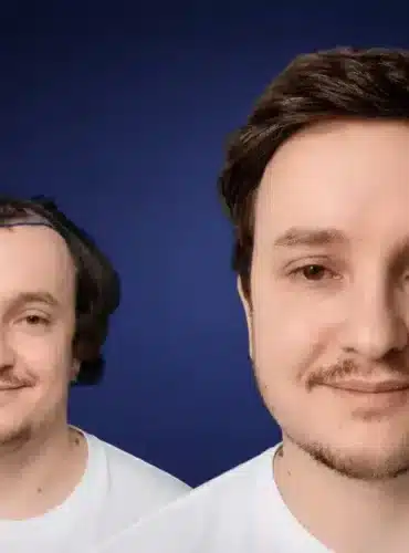 Vorher-Nachher-Frontansicht von Declan P. nach einer Haartransplantation in der Türkei mit 5.600 Grafts bei Cosmedica in Istanbul