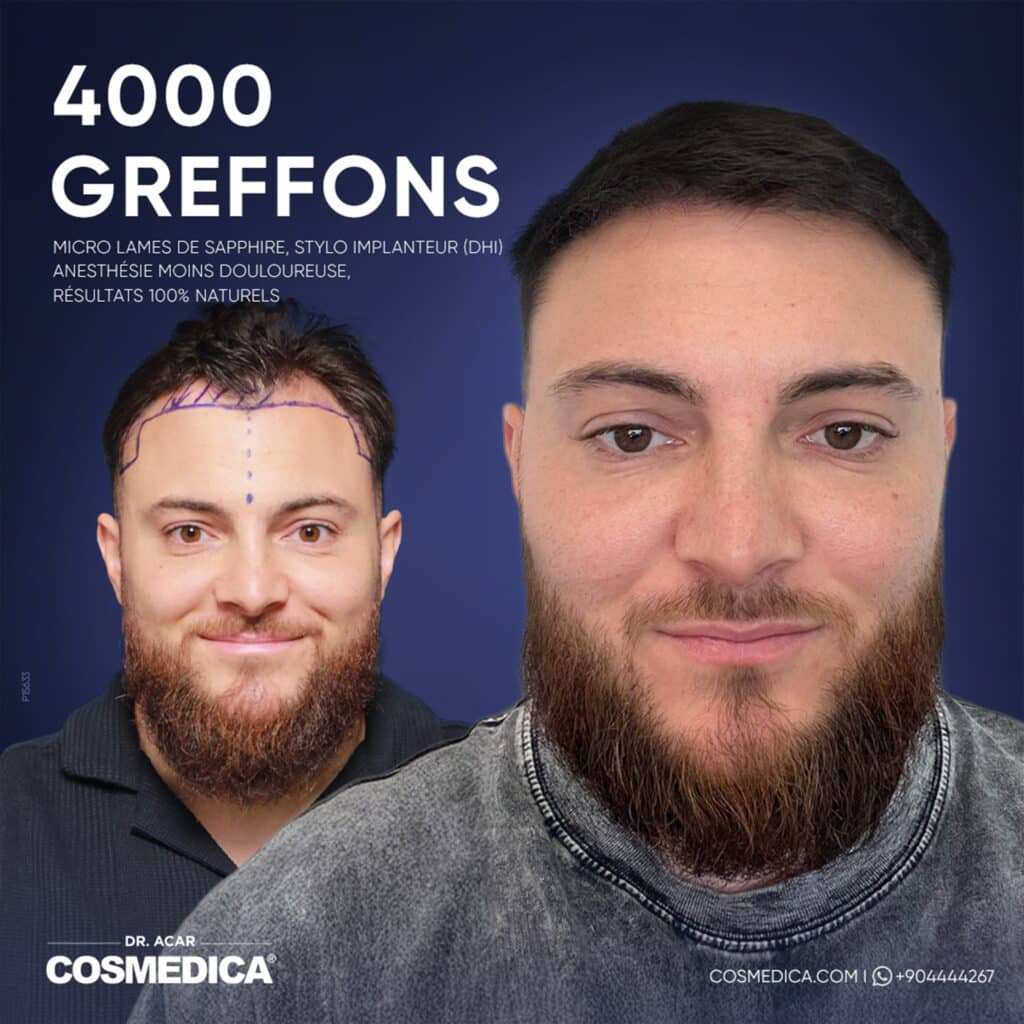 Photos d'une greffe de cheveux avant et après de 4000 greffons chez Cosmedica Clinic
