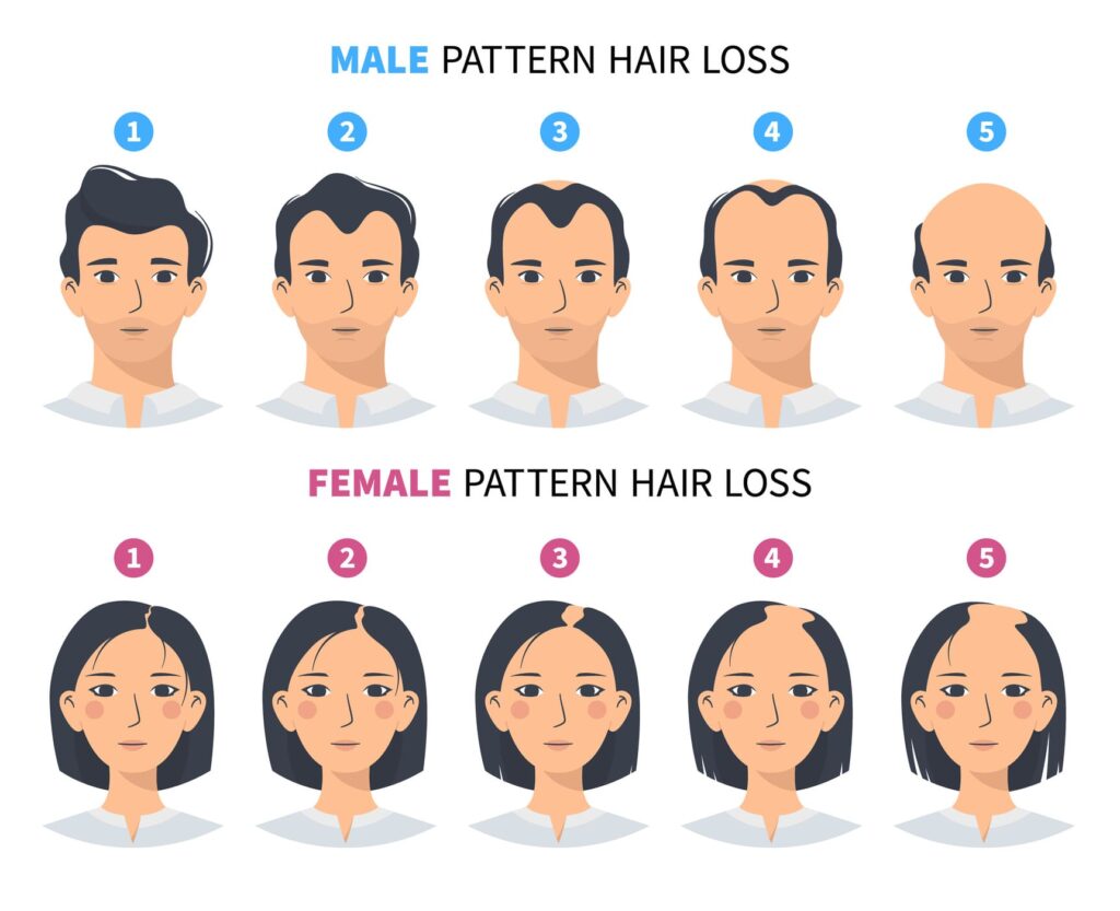 Grafico che mostra gli stadi di perdita dei capelli nell'uomo e nella donna