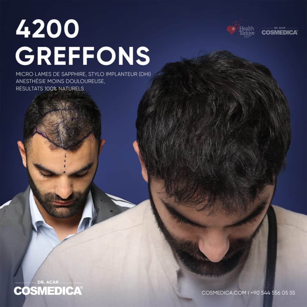 Résultats avant-après d'une greffe de cheveux Micro Saphir DHi de 4200 greffons chez Cosmedica