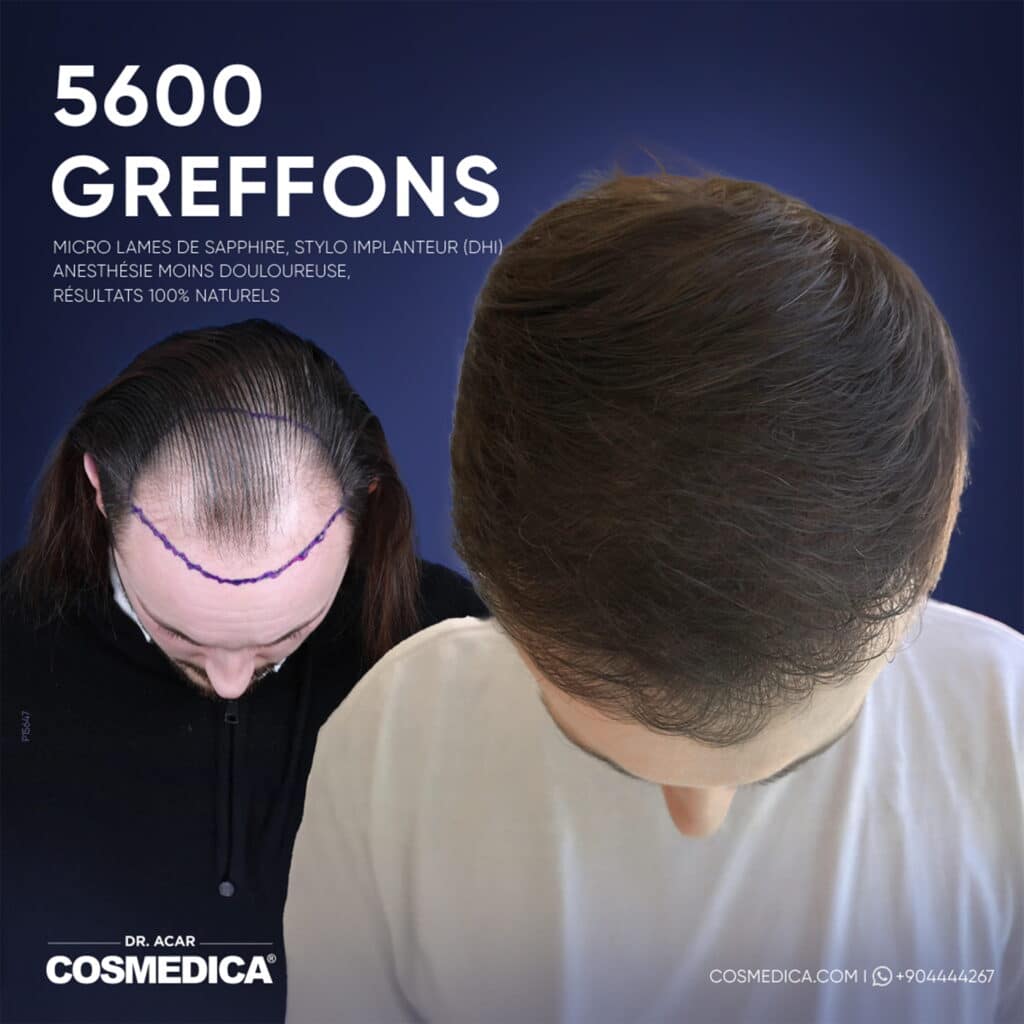Résultats avant-après d'une greffe de cheveux Micro Saphir DHi de 5600 greffons chez Cosmedica