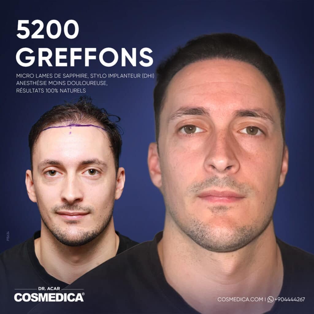 Résultats avant-après d'une greffe de cheveux Micro Saphir DHi de 5200 greffons chez Cosmedica