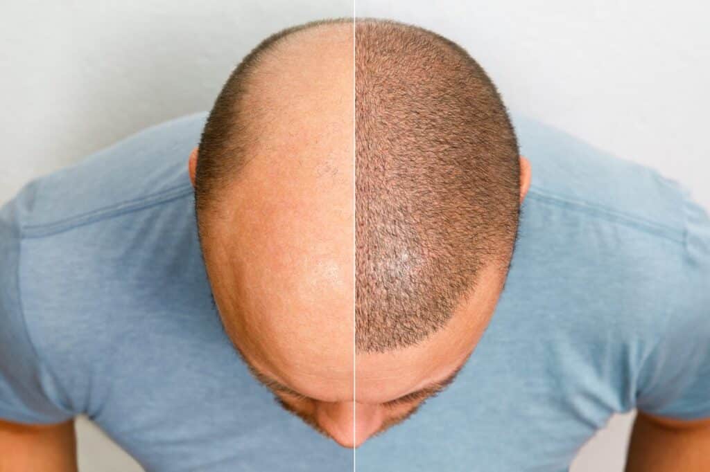 Haartransplantatie na 9 maanden haargroei voor en na