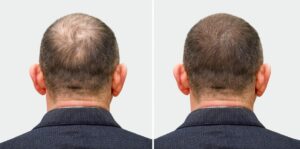 Haartransplantatie na 9 maanden donorgebied voor en na
