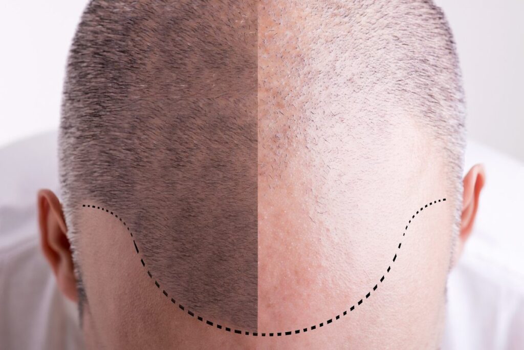 New hair growth 6 months after hair transplant is expected