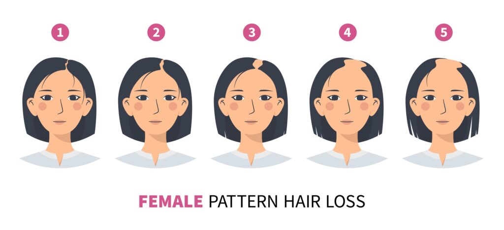 Illustrazione che mostra le fasi della caduta dei capelli, alopecia androgenetica di tipo femminile.