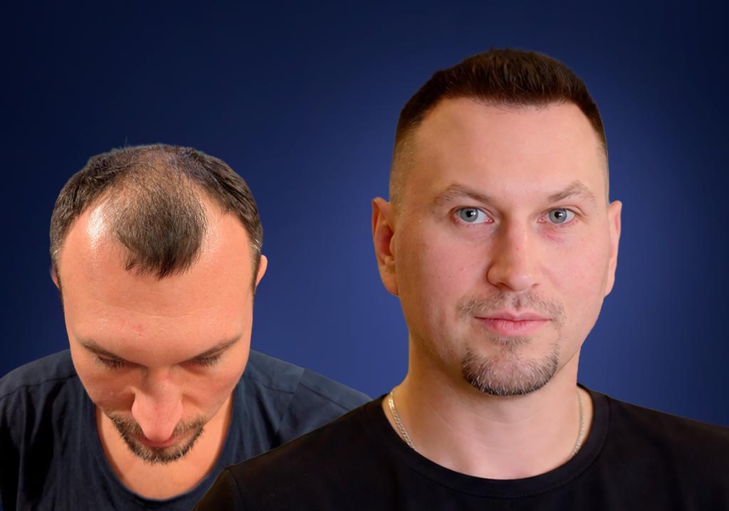 Zdjęcia Pawła przed i po przeszczepie włosów