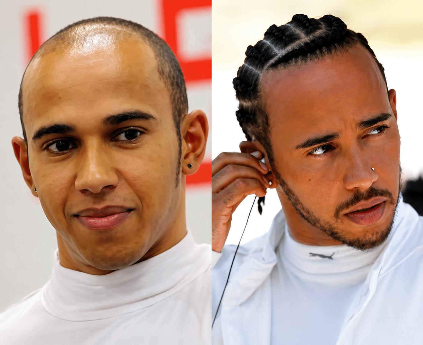 Lewis Hamilton Hair Transplant before and after