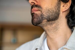 Primo piano di un'alopecia nella barba di un uomo affetto da alopecia areata causata dallo stress lavorativo