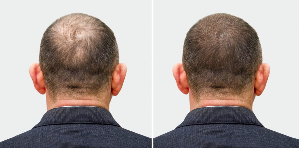 Antes y después del injerto capilar