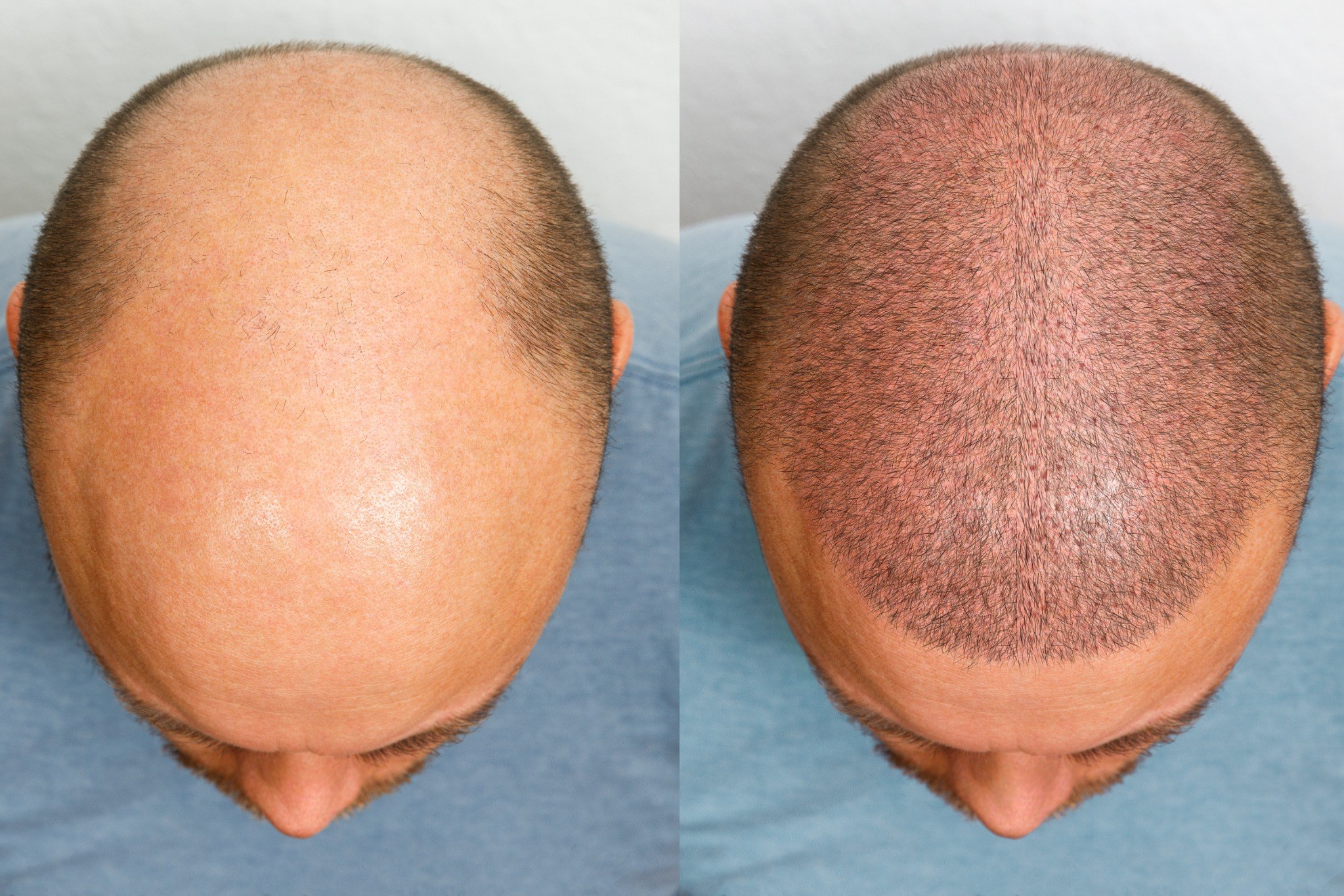 Haargroei na haartransplantatie voor en na met nieuwe haargroei op de hoofdhuid