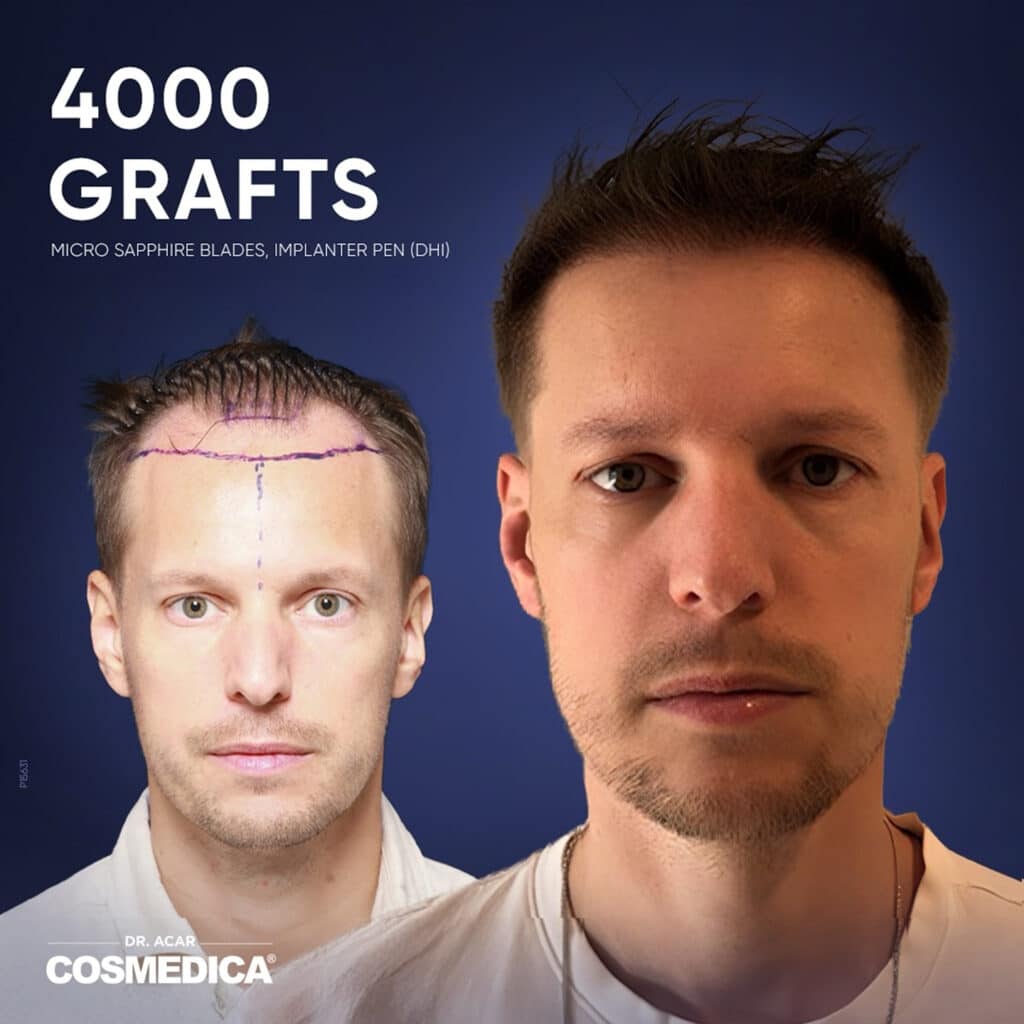 Before and after results of a 4,000 grafts hair transplant at Cosmedica Clinic