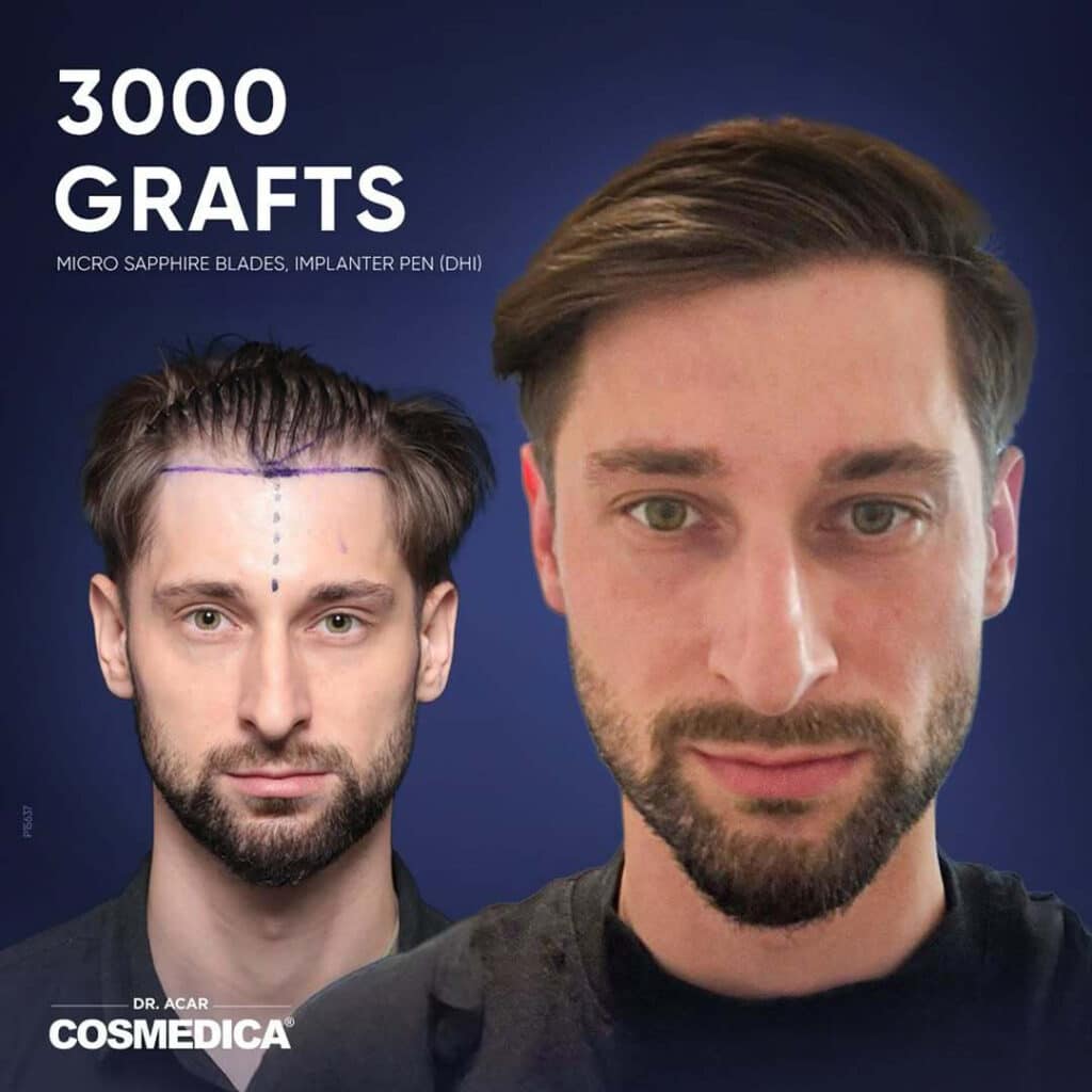 Before and after results of a 3,000 grafts hair transplant at Cosmedica Clinic
