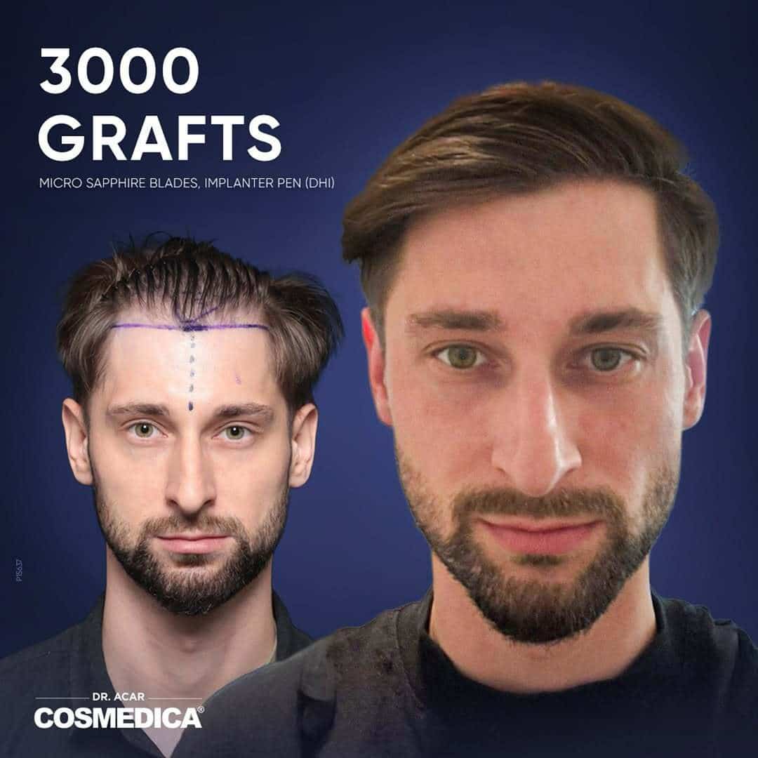 Before-and-after image of one man showing the results of a 3,000-graft hair transplant at Cosmedica Clinic; his pre-transplant appearance with a marked hairline is shown on the left, and his post-transplant appearance is shown on the right.