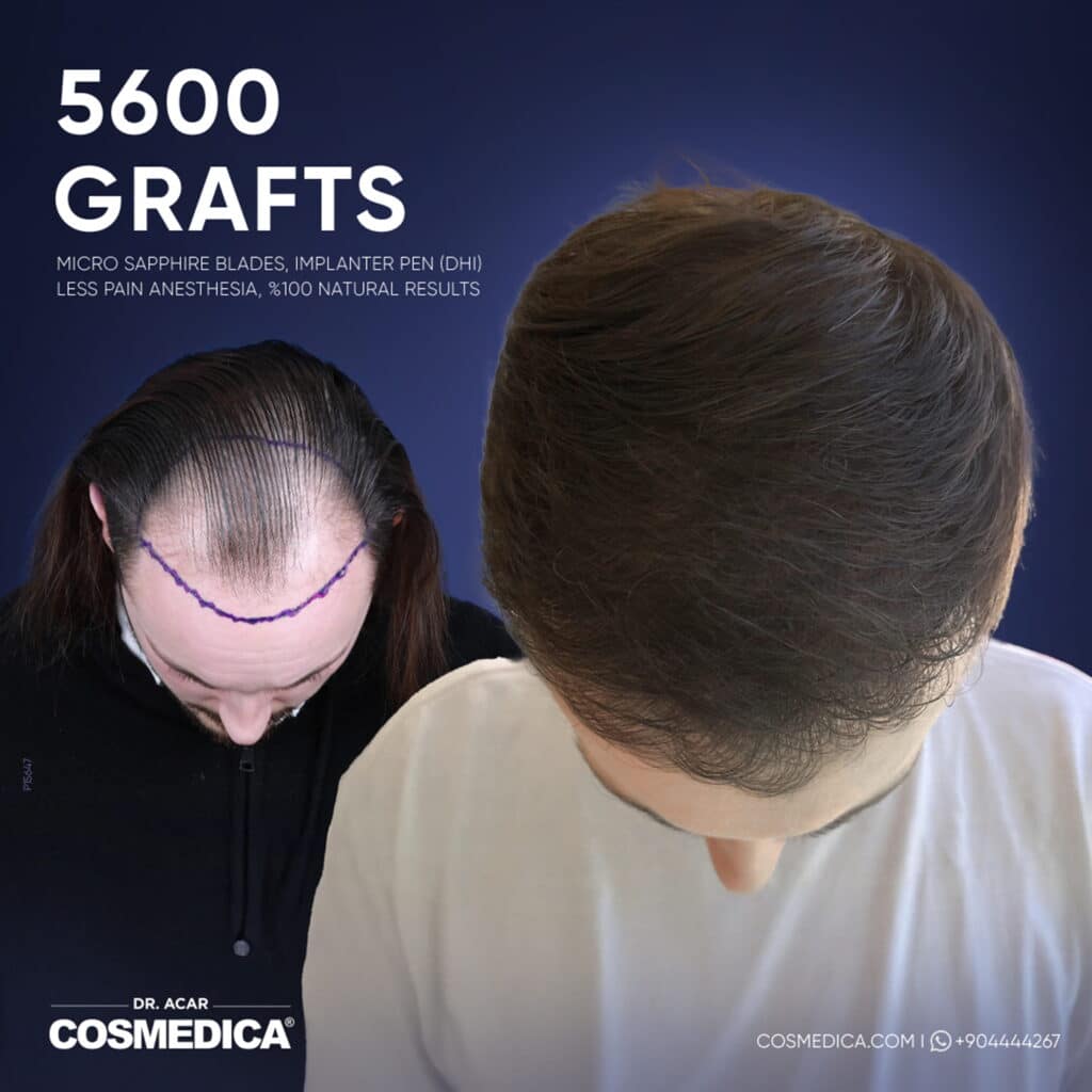 Before and after results of a 5600 grafts Micro Sapphire hair transplant at Cosmedica Clinic