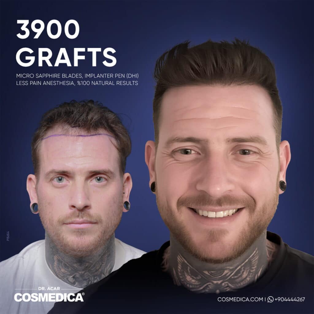 Before and after results of a 3900 grafts Micro Sapphire hair transplant at Cosmedica Clinic