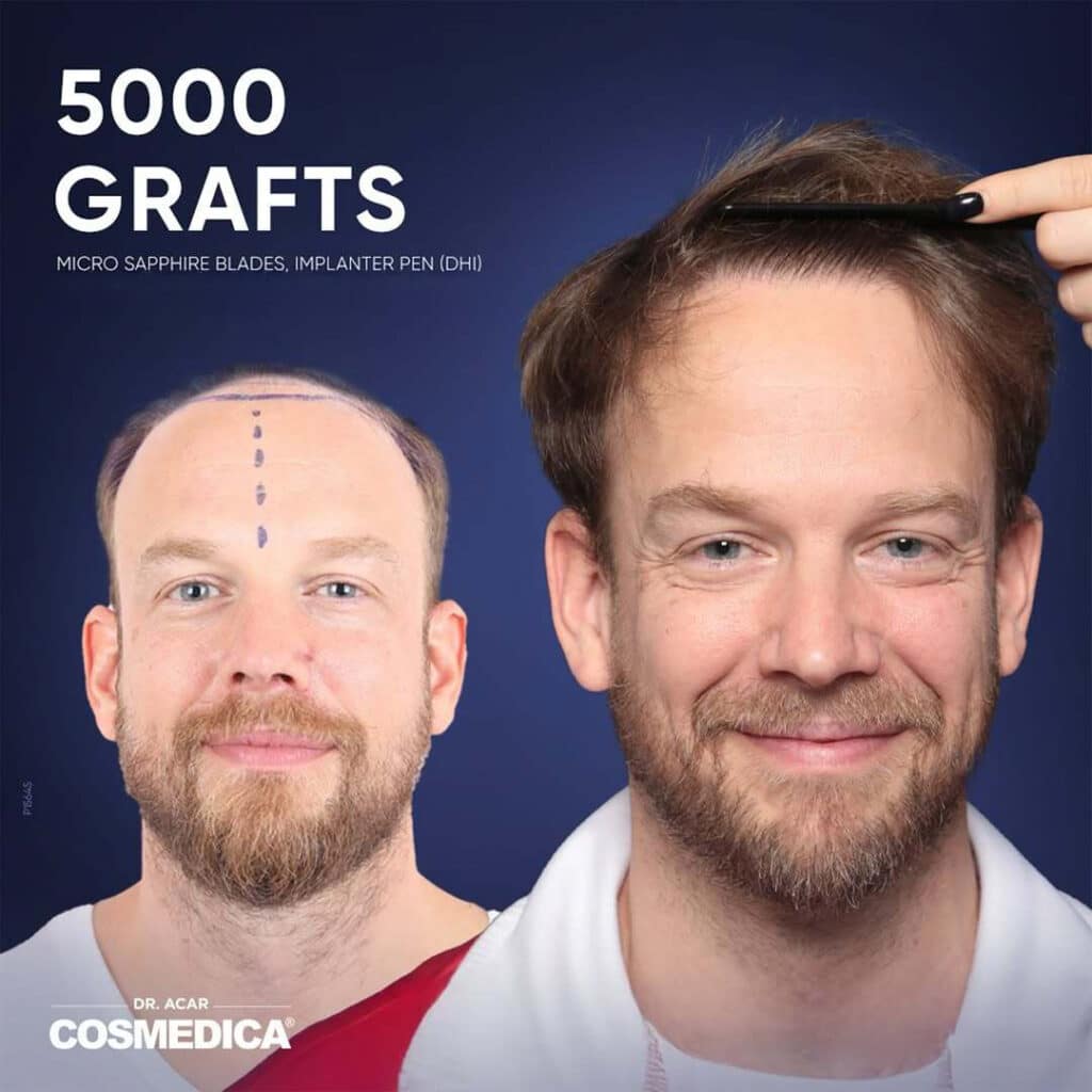 Before and after results of a 5,000 grafts hair transplant at Cosmedica Clinic