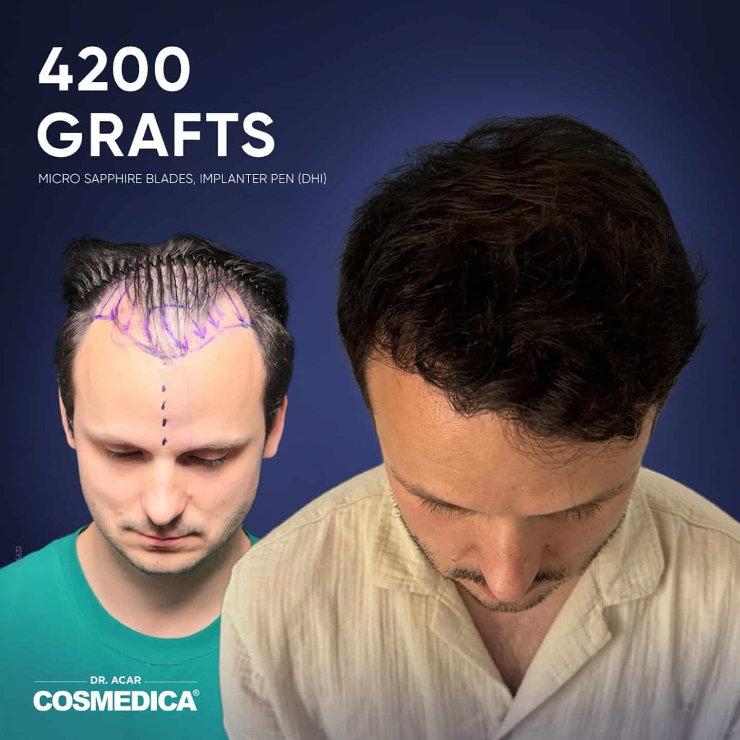 Before-and-after image of one man showing the results of a 4,200-graft hair transplant at Cosmedica Clinic; his pre-transplant appearance with a marked hairline is shown on the left, and his post-transplant appearance is shown on the right.