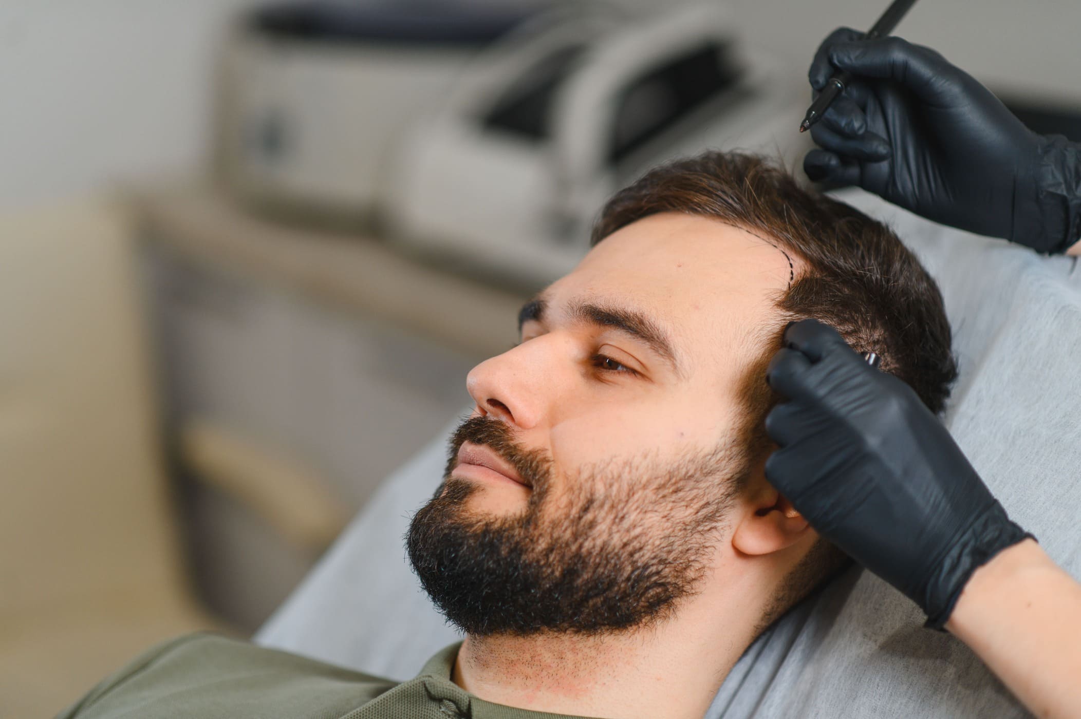 Uomo sottoposto al trapianto di capelli dhi istanbul