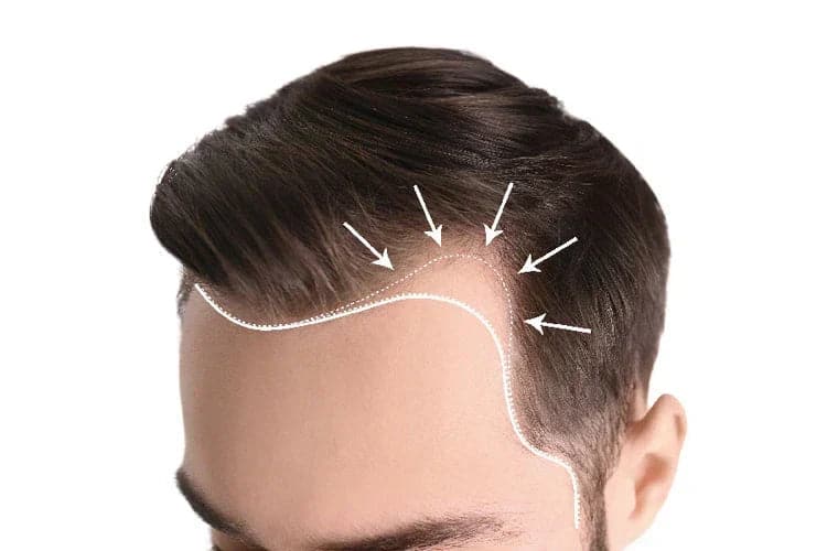 Diferencia entre línea capilar madura y entradas progresivas por alopecia androgenética