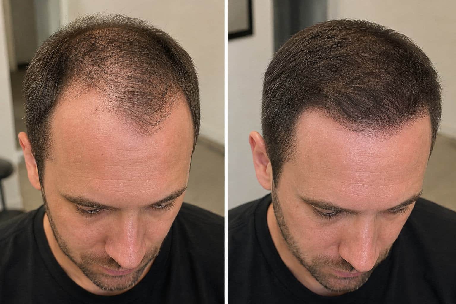 Mature Hairline vs. Receding Hairline comparison showing differences in hair density and frontal recession