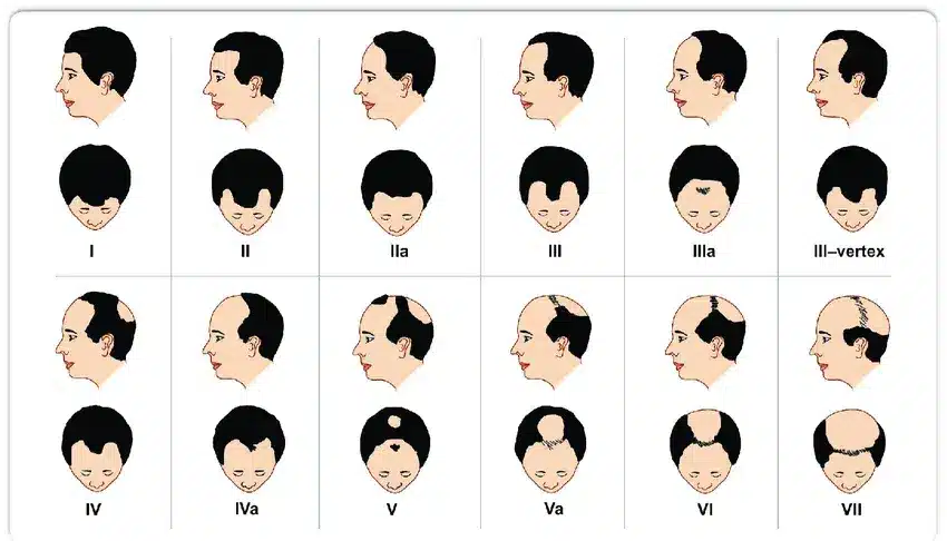 La escala moderna de Norwood-Hamilton mostrando la caída del cabello