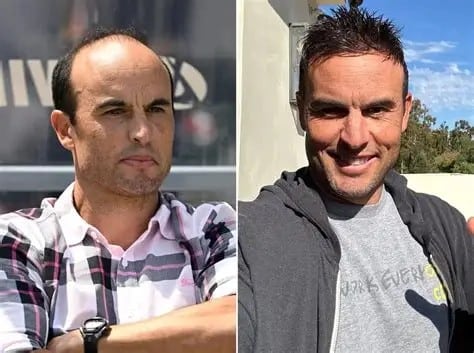 Landon Donovan hair transplant before and after