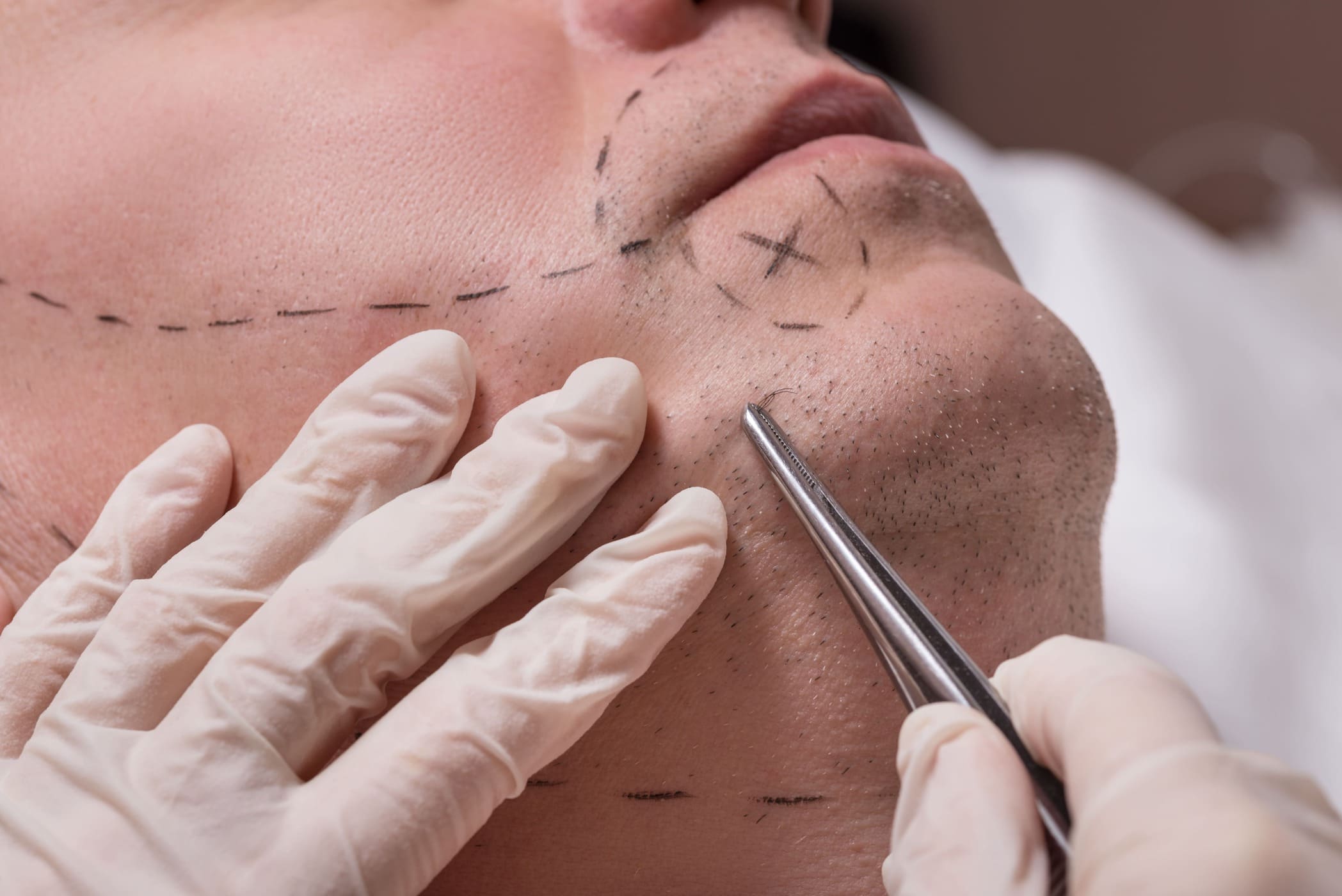 Dottore disegna la linea per il trapianto barba