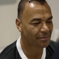 Cafu hair line before hair transplantation in Turkey