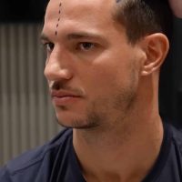 Image of Football player Cedric Soares during his hair transplant consultation at Cosmedica Clinic