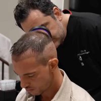 Football player Cedric Soares during his hair transplant analysis at Cosmedica Clinic