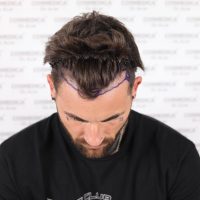 Chris Perceval before his hair transplant at Cosmedica Clinic