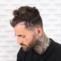 Photo of Chris Perceval before his hair transplant at Cosmedica Clinic