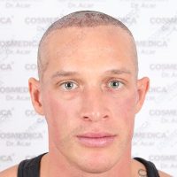 photo of Football player Denis Toplak right after his hair transplant in Turkey at Cosmedica Clinic